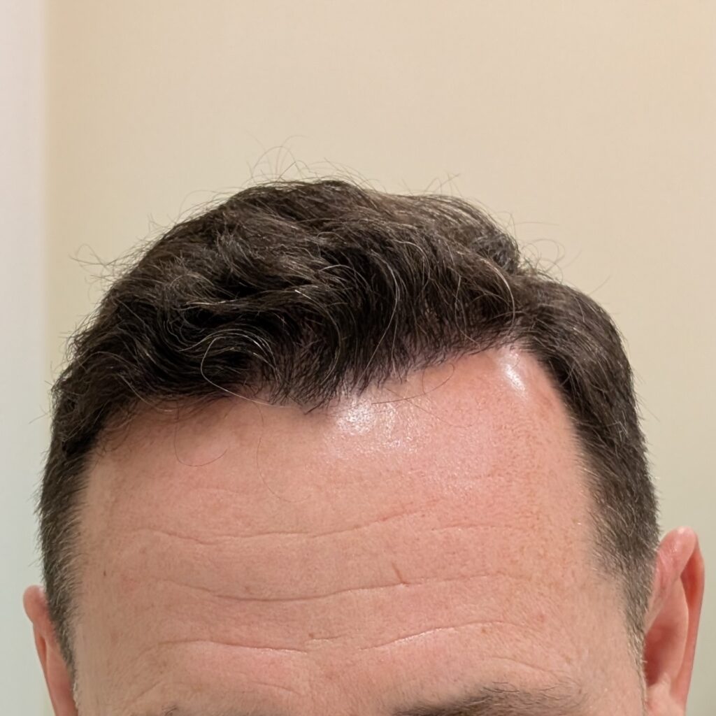 Efekt zabiegu przeszczepu włosów FUE (3500 graftów) w Klinice SmylaHair w Tychach